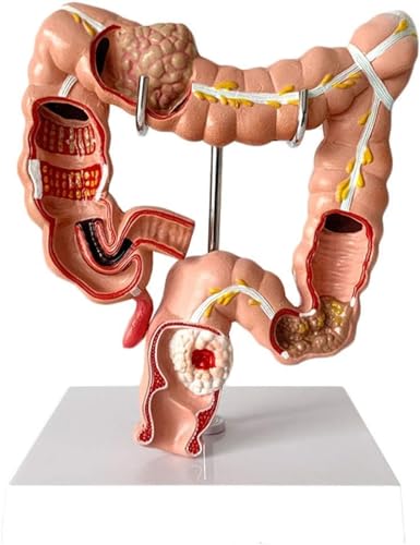 Menschliches Dickdarmläsionsmodell Anorektales Gastroenterologie-Dickdarmmodell Lehrmodell Menschliches Dickdarmanatomisches Modell Viszerales Läsionsmodell - Dickdarmpathologiemodell von VERIMP