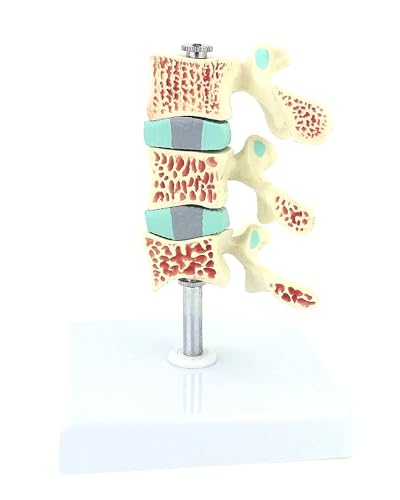 Menschliches Skelett, Osteoporose-Läsionsmodell, Wirbelsäulen- Und Halswirbel-Anatomiemodell 1:1 Osteoporose-Modell Abnehmbare 3 Wirbel Menschliches Skelett Bandscheiben Lendenwirbelsäulenmodell von VERIMP