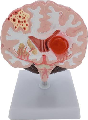 Simuliertes Menschliches Gehirnkrankheitsmodell Gehirnanatomie Neurochirurgie Gehirnpathologie Gehirnläsionsmodell Gehirnmodell - Fehlgebildetes Gehirnpathologisches Modell von VERIMP