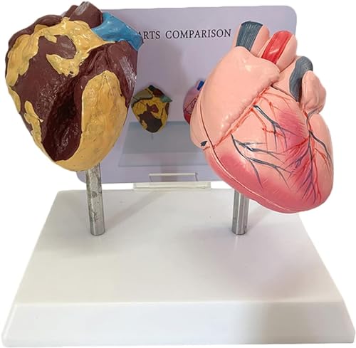 Vergleichsmodell Des Rauchenden Herzens Und Des Gesunden Herzens Pathologischer Patient Herzanatomie Medizinisches Lehrmodell Pathologisches Herzmodell - Menschliches Herzmodell von VERIMP