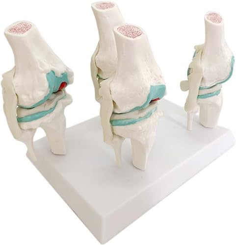 Vierstufiges Erkranktes Kniegelenkmodell, Erkranktes Kniegelenkmodell Menschliches Skelettmodell Skelett Vier Stufen Pathologischer Gelenke - Kniegelenkmodell - Medizinische Anatomie Flexibles Knie von VERIMP