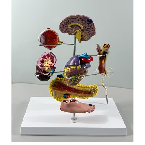 Type II Diabetes Model Set, Replica for Human Anatomy and Physiology Education, Anatomy Model for Doctor's Offices and Classrooms, Medical Learning Resources von Xinzhai