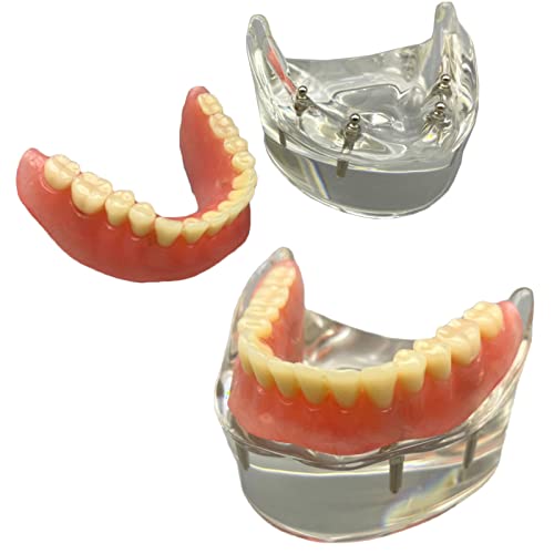 Zahnimplantat Modell - Overdenture 4 Implantate Modell - Transparentes Demo Dental Zahnmodell für Studie Erwachsene Standard Lehrmodell (Untere Zähne) von YC°