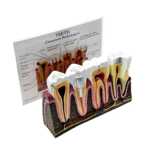 Zahnstruktur-Lehrmodelle 11,2 * 16 * 10 cm, Zahnmodell zur Wurzelkanaldemonstration, abnehmbare Zahnmodelle 1 Stück Zahnstruktur-Lehrmodelle 11,2 * 16 * 10 cm, Zahnmodell zur Wurzelkanaldemonstration, abnehmbare Zahnmodelle 1 Stück von YJQHODY