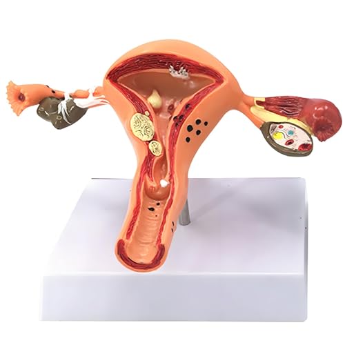 buyzg Weibliche Gebärmutter Eierstock Modell Pathologie Menschliche Gebärmutter Eierstock Krankheit Dissektion Biologie Lehrmittel Anatomie Läsion Modell buyzg Weibliche Gebärmutter Eierstock Modell Pathologie Menschliche Gebärmutter Eierstock Krankheit Dissektion Biologie Lehrmittel Anatomie Läsion Modell von buyzg