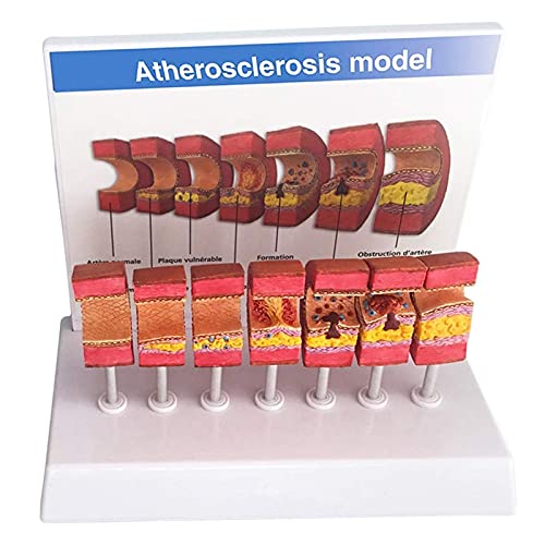 Anatomie-Modell der menschlichen Arterie, anatomisches Gefäß, Atherosklerose, Thrombus-Gefäßmodell, pädagogische Lernhilfe, Laborbedarf von sdjfhehfdcbfvhfrvd